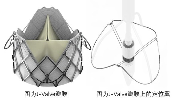 J-Valve瓣膜上的定位翼完全張開，可以找到主動(dòng)脈竇并能自我調(diào)整對(duì)準(zhǔn)瓣膜植入點(diǎn)；杰成將這一過程命名為“自主導(dǎo)航定位系統(tǒng)”