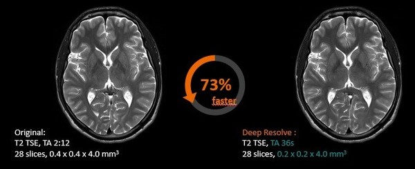 Deep Resolve可將顱腦掃描時(shí)間降低70%，并將成像分辨率提高2倍，并可保持相同的圖像質(zhì)量